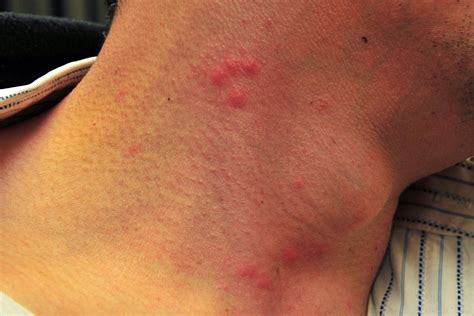 How A Bed Bug Bite Looks Like at Karen Smith blog