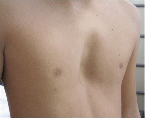 Pectus Excavatum Causes