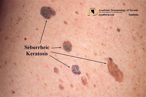 Seborrheic Keratosis Skin Lesions - vrogue.co