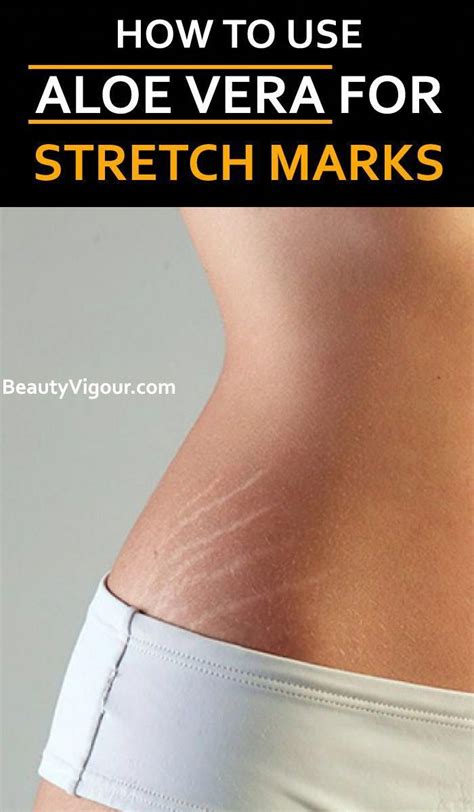 Aloe Vera for Stretch Marks #AloeVeraBeautyHacks | Stretch marks, Aloe vera, Aloe vera for hair