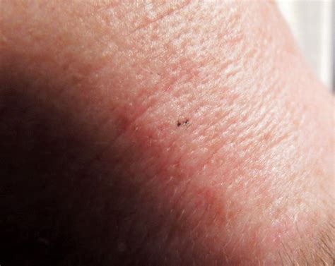 Dark irregular spot on forehead about 2 to 3mm across, thoughts? : r ...