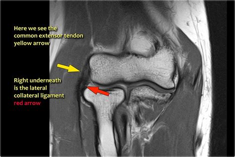 MRI Protocols: ELBOW MRI ANATOMY