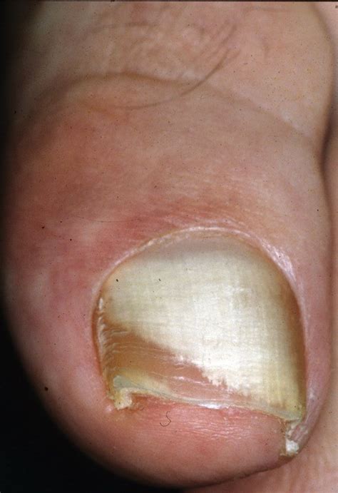 Endonyx onychomycosis: white discoloration of the nail plate that is ...