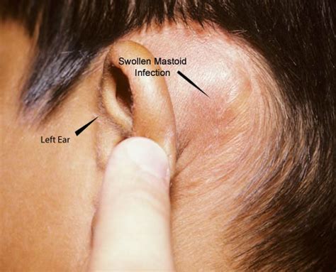 Right Mastoid Sinus Disease