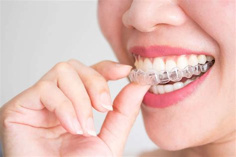 Invisalign Vs Braces: The Differences You Need To Know