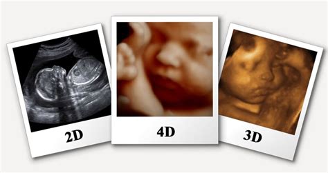 3d/4d Ultrasound Scan – 4d Diagnostics