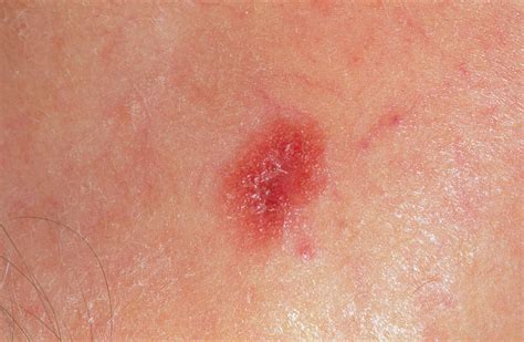 Ammazza! 40+ Elenchi di Skin Melanomas Images: Some images of melanomas are shown below ...