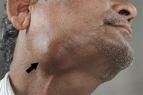 Submandibular Lymph Nodes Dermatology Itch Icon Downl - vrogue.co