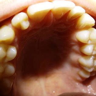 Examples of talon cusp types; a type I talon cusp in maxillary right ...