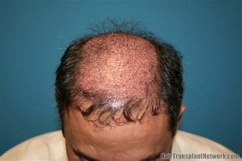 Surgery - Hair Restoration Network - Community For and By Hair Loss ...