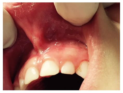 IJERPH | Free Full-Text | Laser Surgical Approach of Upper Labial Frenulum: A Systematic Review