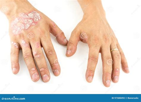 Psoriasis Vulgaris On The Mans Hands With Plaque, Rash And Patches On ...