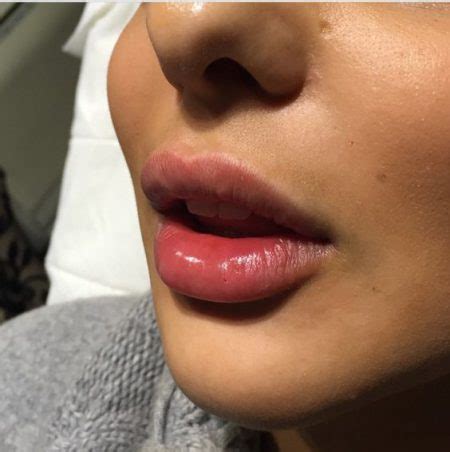 LIP Fillers & Why Is Everyone Getting Them?! - The Fashion Tag Blog