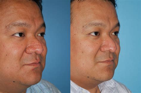 Before and After - Rhinophyma |Dr. Sidle