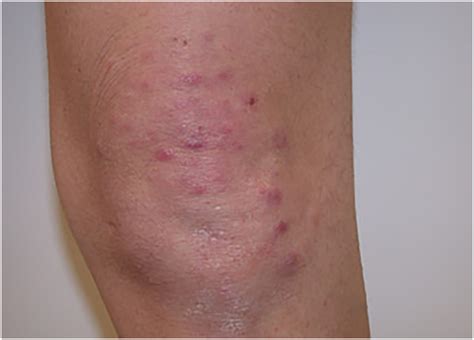 Image Gallery Lymphoma Rash Itching - Riset