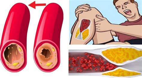 Here Are 7 Warning Signs You Have Blocked Arteries - Health Remedies Article