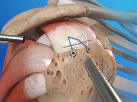 Video - Rotator Cuff Repair (Arthroscopic) - HealthClips Online