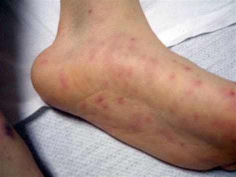 Meningococcal Disease: Causes, Symptoms & Treatment