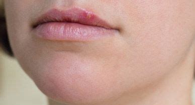 Bumps on Lips: Causes, Treatments, and More