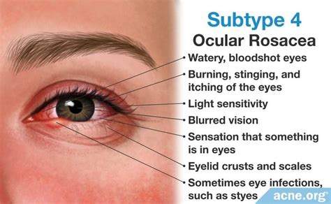 Ocular Rosacea: Beverly Hills Optometry: Advanced Dry Eye Center: Optometrists