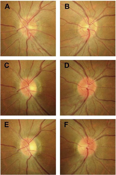 Disc photography findings of the OS and OD optic discs. Disc ...