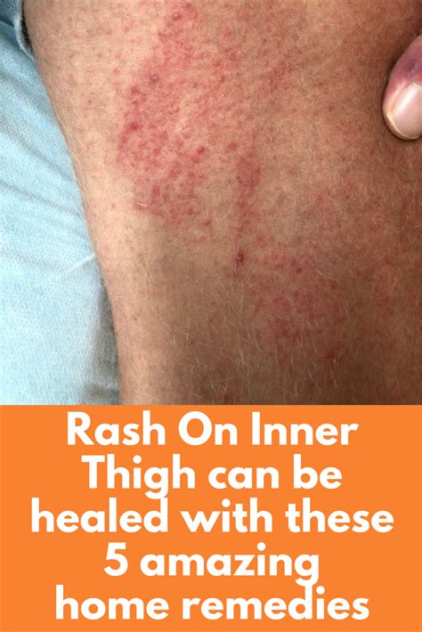 How To Treat Heat Rash Between Thighs at Amee Noga blog