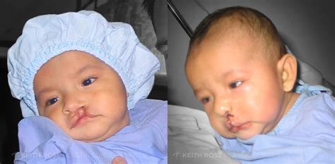 Cleft Lip Before & After Photos | J. Keith Rose, MD - Part 2