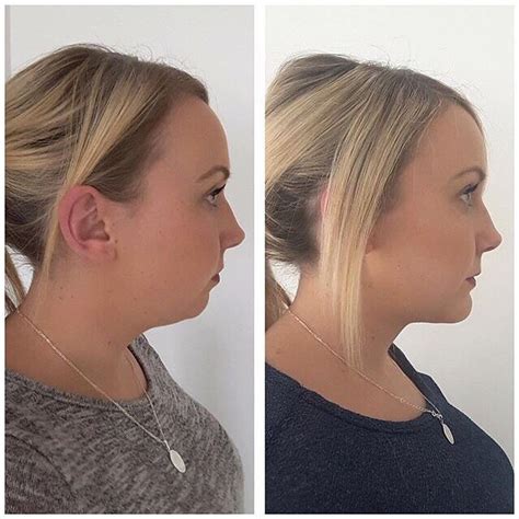 rf treatment for double chin - lucich-india