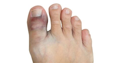 Broken Toe - Symptoms, Causes, Treatment & Rehabilitation