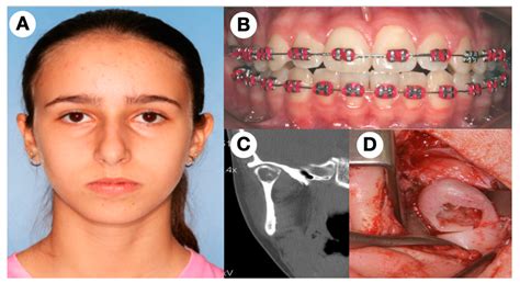 JCM | Free Full-Text | Central Giant Cell Granuloma in the Mandibular Condyle in a Teenager. A ...