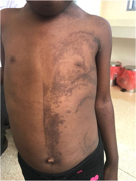 Isolated nevus unius lateralis in a patient from Uganda