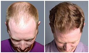 Treatment Options for Hair Loss - Bosley Hair Transplant