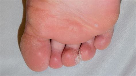 Mosaic Warts: Symptoms, Causes, Treatments, and More