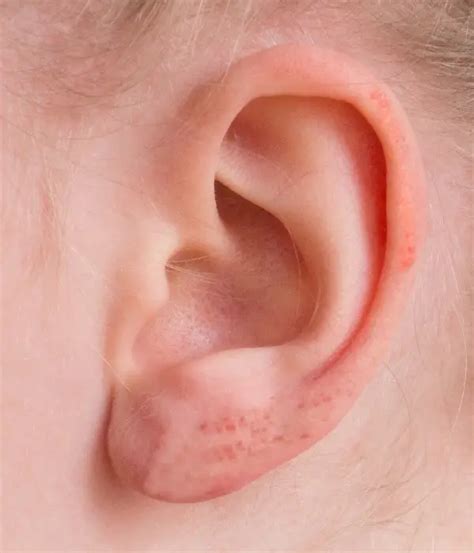 Complete Ear Eczema Guide: Causes, Symptoms, Treatments & More