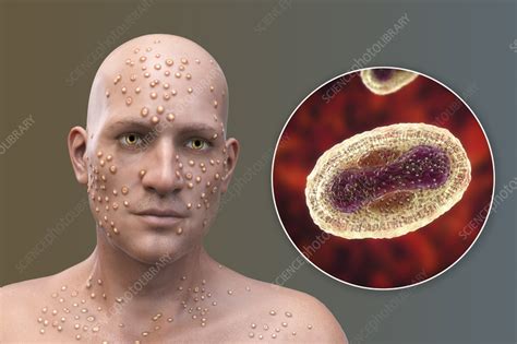 Smallpox virus infection, illustration - Stock Image - F036/6653 - Science Photo Library