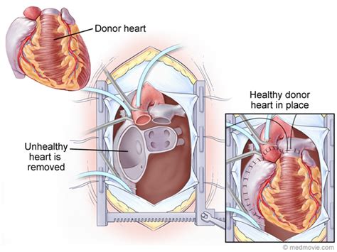 heart transplantation