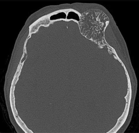 Cureus Intraosseous Orbital Cavernous Hemangioma With Frontal | My XXX ...