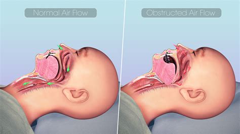 Sleep Apnea: Causes, Symptoms, and Treatment - Scientific Animations