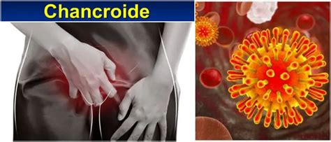 Chancroide: Definición, Causas, Factores de Riesgo, Síntomas ...