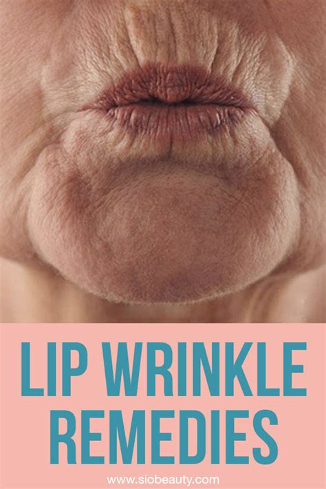 The 6 Best Upper Lip Wrinkle Treatments