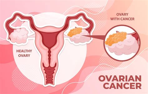 Ovarian Cancer Infographic 3095859 Vector Art at Vecteezy