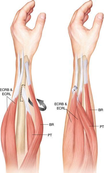 Tendon transfer surgery : Author's experience - Spinal Injury Information network