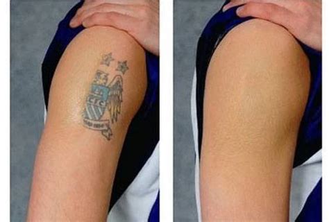 Tattoo Removal Home Remedies: Natural & Permanent - 9jafoods