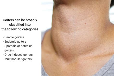 Goiter: Causes, Symptoms, Types, Diagnosis, & Home Remedies