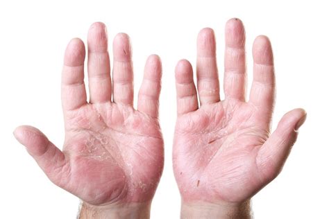 Hand Eczema: Causes, Symptoms and Treatment Options - Reorion Planet