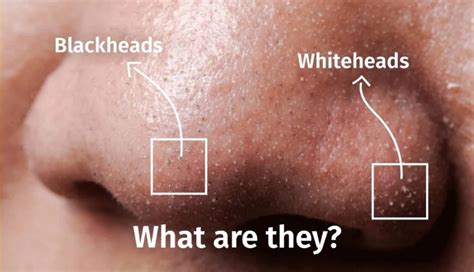 What Are Whiteheads And How To Get Rid Of Them? – Depology