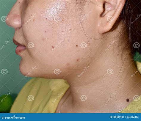 Acne Vulgaris, Black Spots And Scars On Face Of Asian Young Woman ...