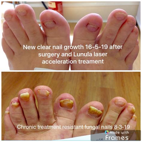 Die Geduld der Kellner Eimer laser treatment for toenail fungus success rate Abschied Manga ...