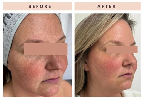 Sun Spot Removal | Dermatologist In Jericho, NY | Jason Applebaum, M.D., F.A.A.D.