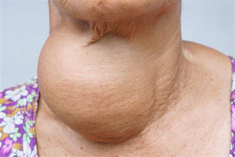 Common Thyroid Disorders | Page 4 | Things Health